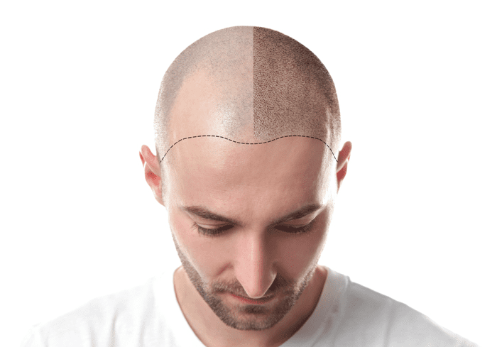 Hair Transplant Vs Hair Replacement.